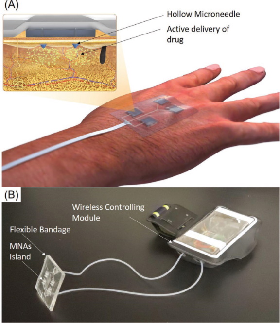 A Wireless Smart Bandage with Miniaturized Needle Arrays