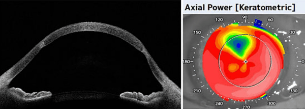 Corneal Stiffening to Improve Surgical Outcomes