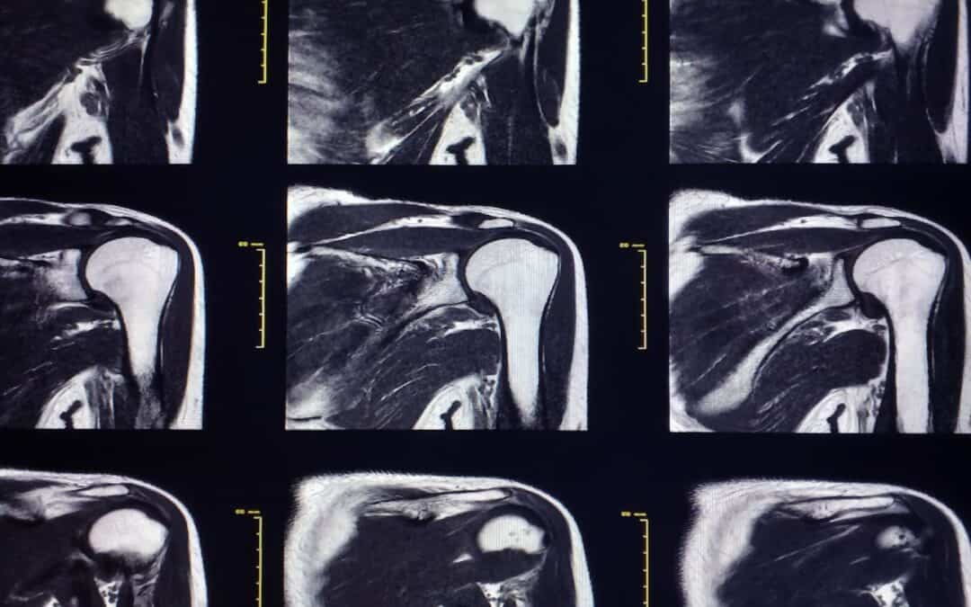 Finite Element Modelling of Rotator Cuff Tears  